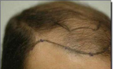 Hair restoration procedure results