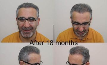 Hair transplant surgery before and after photos