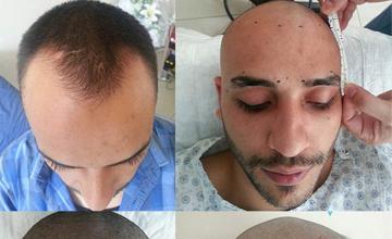 Hair transplantation surgery before and after images