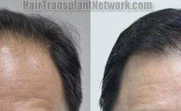 Hair restoration procedure before and after results