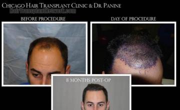 Hair restoration procedure before and after results