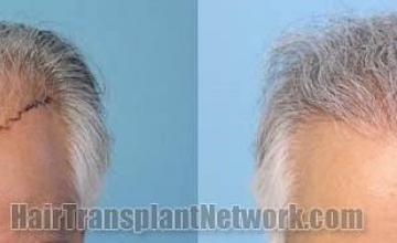 Before and after hair transplant procedure images