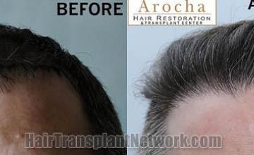 Hair restoration procedure before and after results