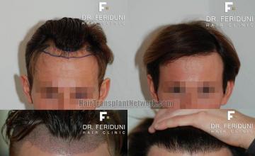 Hair restoration procedure before and after results