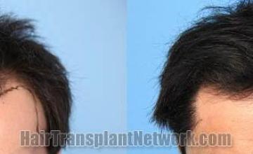 Hair restoration procedure before and after results