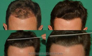 Hair restoration procedure before and after results