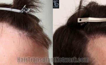 Hair transplantation surgery before and after pictures