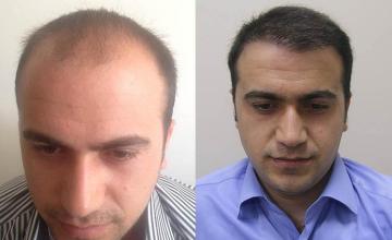 Front view - Before and after hair transplant surgery result images