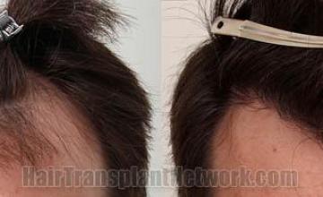 Hair restoration procedure before and after results