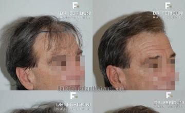 Hair transplantation surgery before and after images