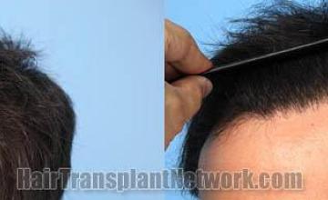 Hair transplantation surgery before and after pictures