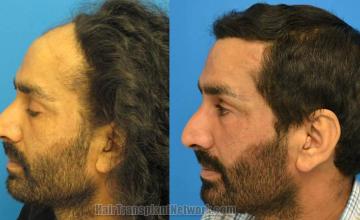 Hair transplantation surgery before and after pictures