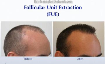 Hair transplantation surgery before and after photos