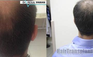 Hair restoration procedure before and after pictures