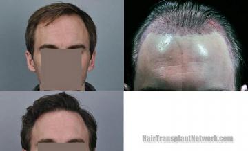 Hair transplantation surgery before and after photos