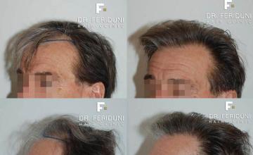 Hair transplantation surgery before and after pictures