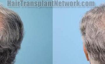 Hair transplantation surgery before and after pictures