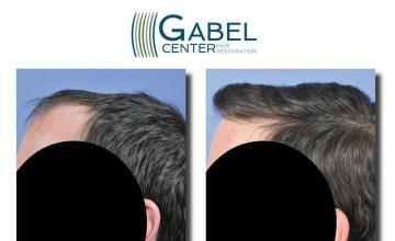 Hair transplantation surgery before and after images