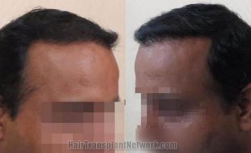 Hair transplantation surgery before and after images