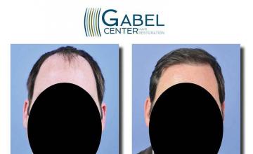 Hair restoration procedure before and after results