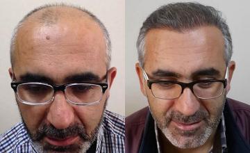 Before and after hair transplant procedure images