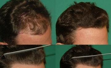 Hair transplantation surgery before and after images