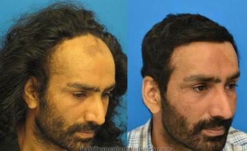 Hair restoration procedure before and after pictures