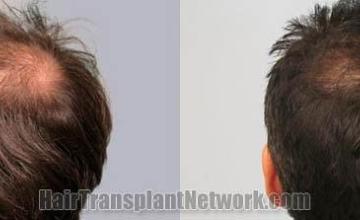 Hair restoration procedure before and after pictures