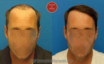 Hair restoration procedure before and after results