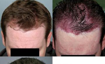 Hair restoration procedure before and after results