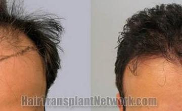 Hair restoration procedure before and after results