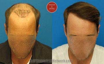 Hair restoration procedure before and after pictures