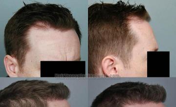 Hair transplantation surgery before and after photos