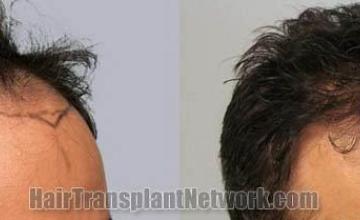 Hair transplantation surgery before and after images