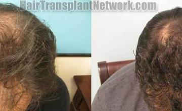 Hair restoration procedure before and after results