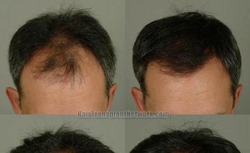 Hair transplantation surgery before and after photos