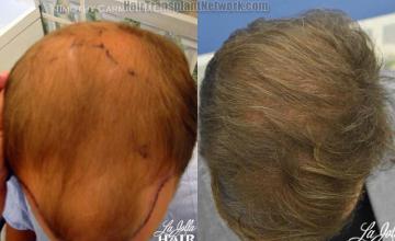 Top view before and after hair restoration results