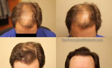 Hair transplantation surgery before and after photos