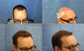 Hair transplantation surgery before and after pictures