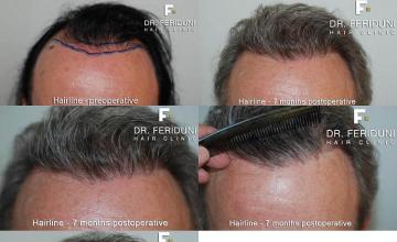 Hair transplant surgery before and after images