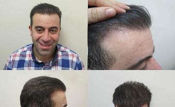 Hair transplant surgery before and after photos