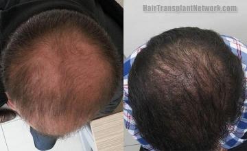 Hair restoration procedure before and after result photographs