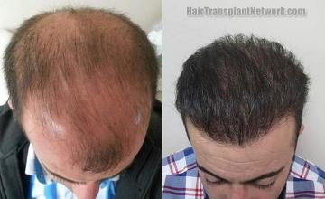 Hair transplantation surgery before and after images