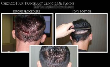 Hair restoration procedure before and after pictures