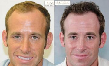 Hair restoration procedure before and after results