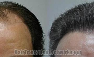 Hair restoration procedure before and after results