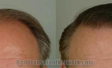 Hair restoration procedure before and after results