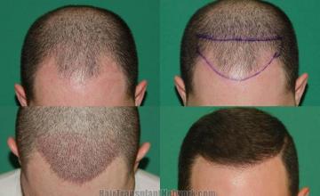 Hair restoration procedure before and after results