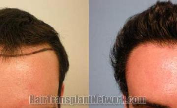 Hair transplantation surgery before and after images