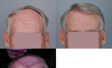 Hair restoration procedure before and after results